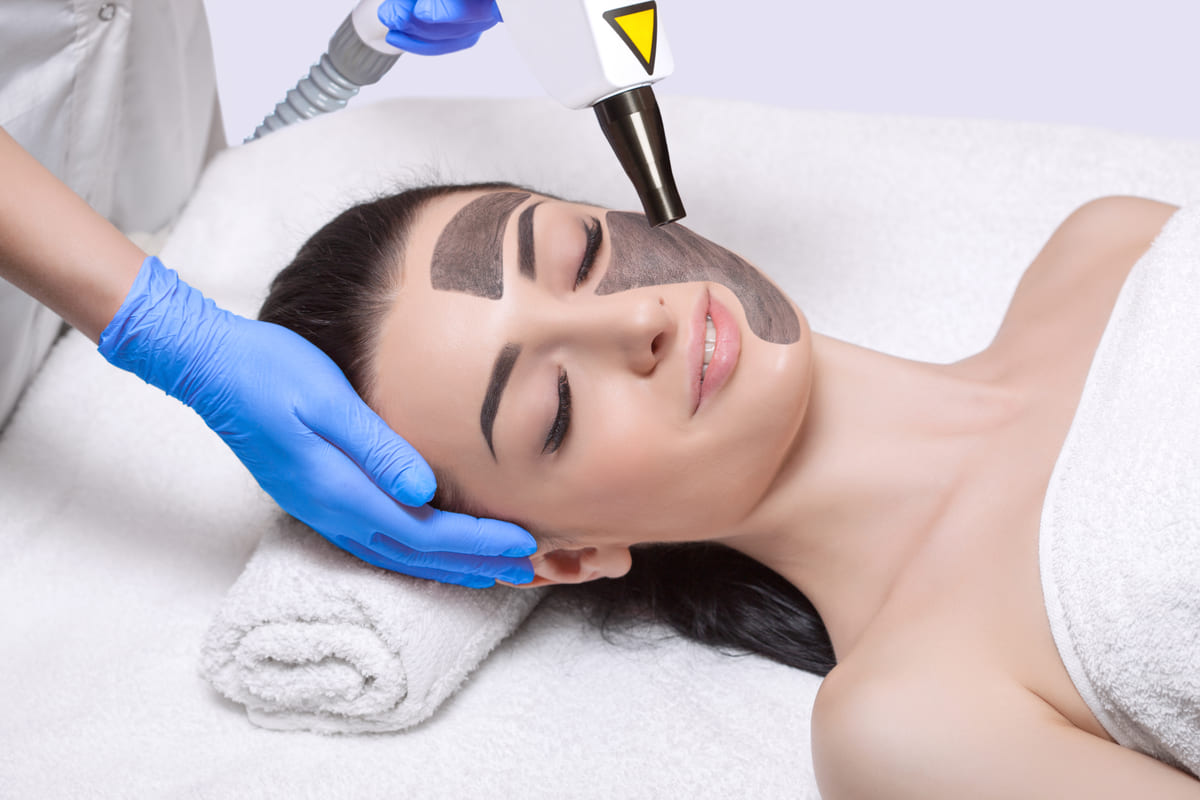 trattamento viso peeling laser